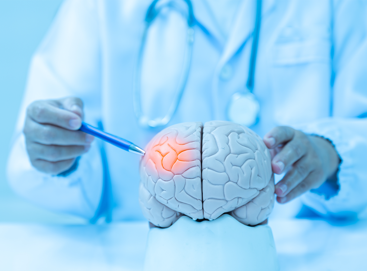 What Everyone Needs to Know About Stroke: A Comprehensive Guide